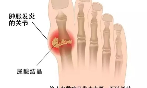 痛风忌口不能吃什么东西一览表痛风-痛风都忌什么东西不能吃专区_痛风忌讳吃什么东西专区_痛风禁忌吃什么食物网